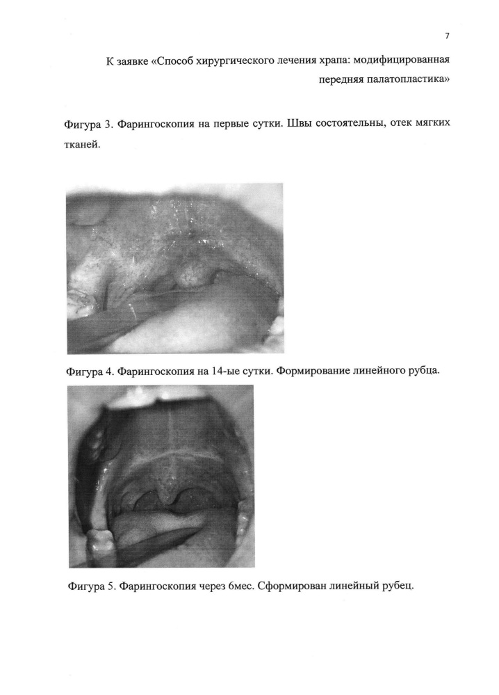 Способ хирургического лечения храпа: модифицированная передняя палатопластика (патент 2632787)