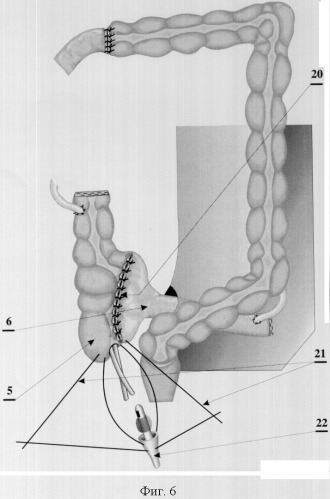 Способ илеоцекоцистопластики (патент 2323688)