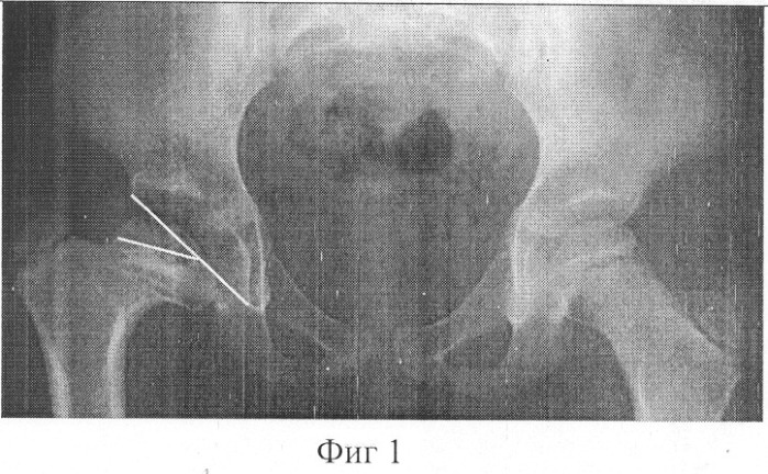 Способ лечения деформации проксимального отдела бедра (патент 2256423)