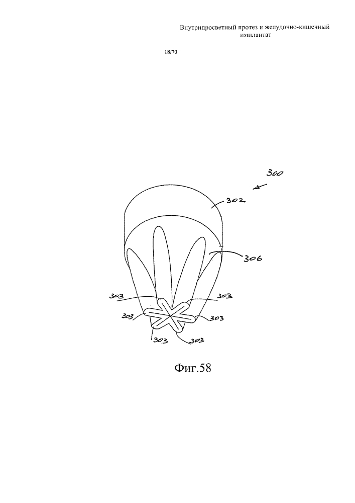 Внутрипросветный протез и желудочно-кишечный имплантат (патент 2626885)