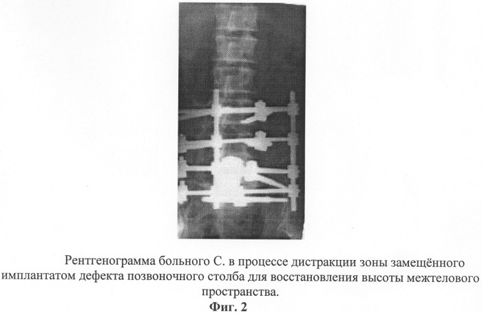 Способ хирургического лечения опухолей позвоночника (патент 2279860)