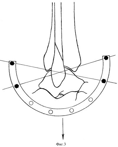 Способ репозиции наружной лодыжки при оперативном лечении застарелых повреждений голеностопного сустава (патент 2403881)