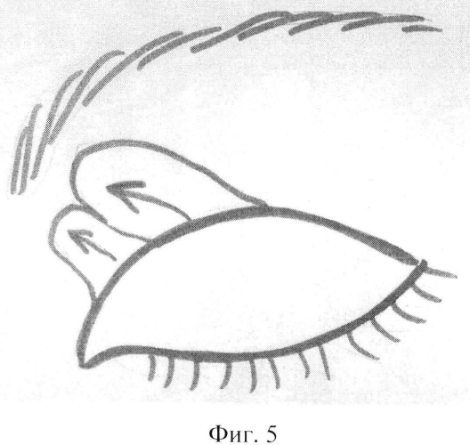 Способ хирургической коррекции а-образной деформации верхних век (патент 2578092)