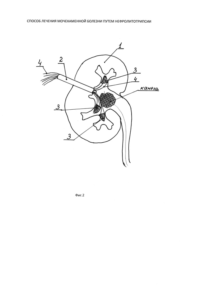 Способ лечения мочекаменной болезни путем перекутанной нефролитотрипсии (патент 2633594)