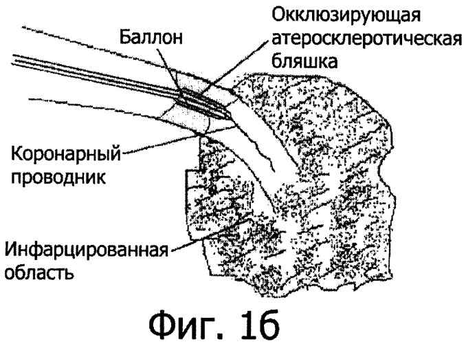 Способ лечения острого инфаркта миокарда (патент 2343921)