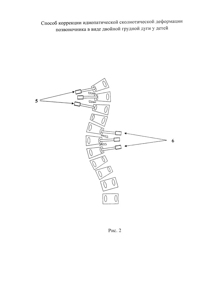Способ коррекции идиопатической сколиотической деформации позвоночника в виде двойной грудной дуги у детей (патент 2651111)