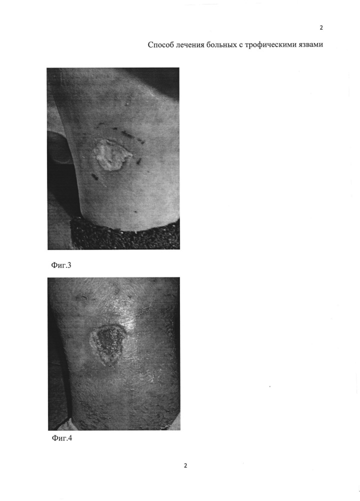 Способ лечения больных с трофическими язвами (патент 2620498)