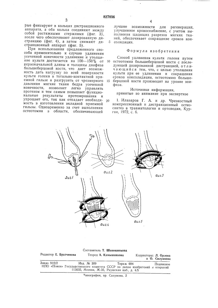 Способ удлинения культи голени (патент 827036)