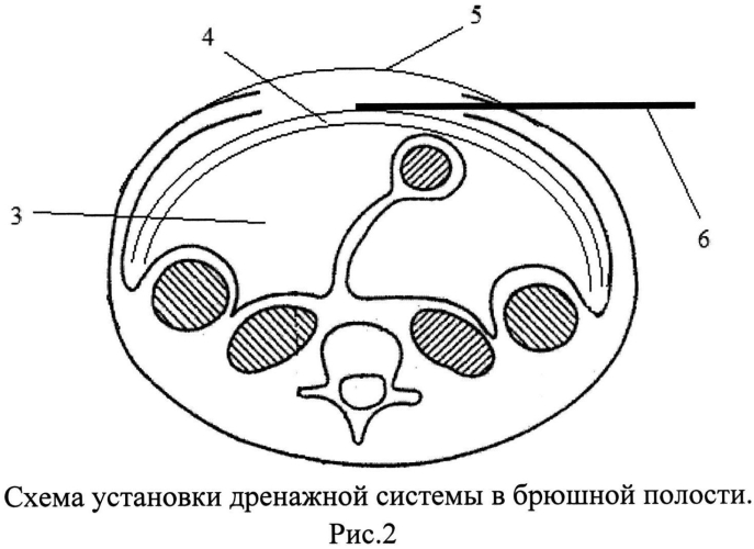 Способ создания активной лапаростомии (патент 2567666)