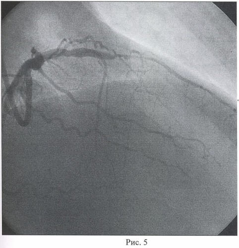Способ коррекции окклюзии коронарной артерии (патент 2456934)