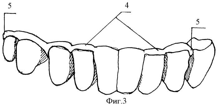 Усовершенствованная несъемная стоматологическая шина и способ ее крепления (патент 2422115)