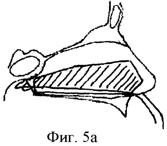 Внутриносовая шина (варианты) и способ ее фиксации (патент 2414180)