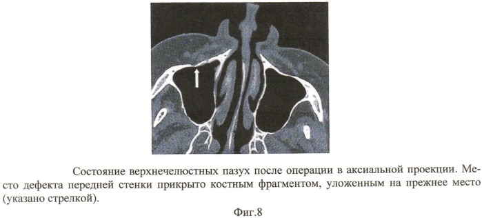 Способ хирургического лечения хронического дакриоцистита (патент 2532014)
