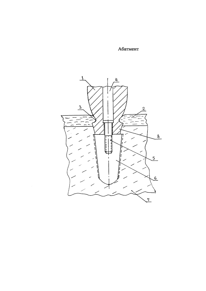Абатмент (патент 2639792)