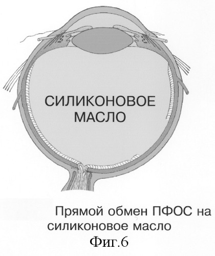 Способ электрохимической деструкции, хирургического удаления и фотодинамической профилактики рецидивов внутриглазных новообразований в среде перфторорганического соединения (варианты) (патент 2244533)