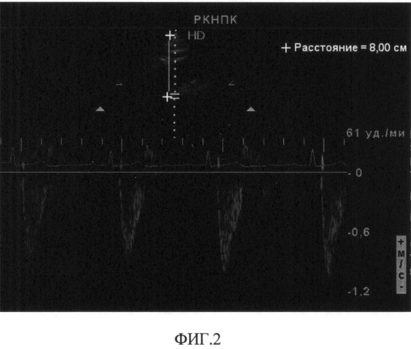 Способ выявления повышенной жесткости аорты у пациентов с кардиопатологиями (патент 2511059)
