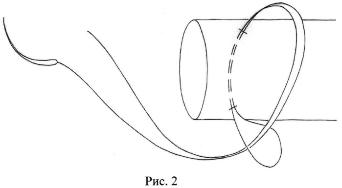 Способ наложения сухожильного шва (патент 2500356)