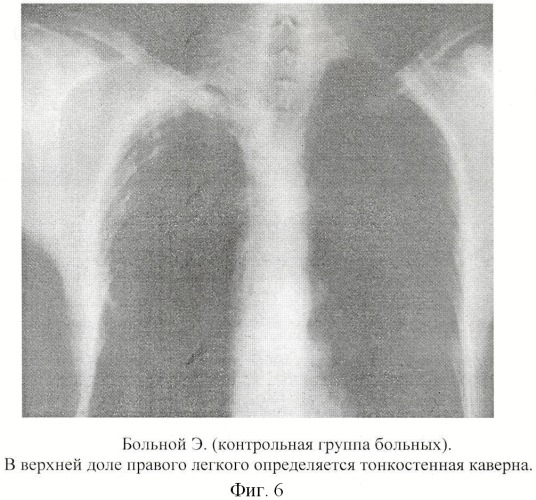 Способ хирургического лечения туберкулеза легких (патент 2417762)