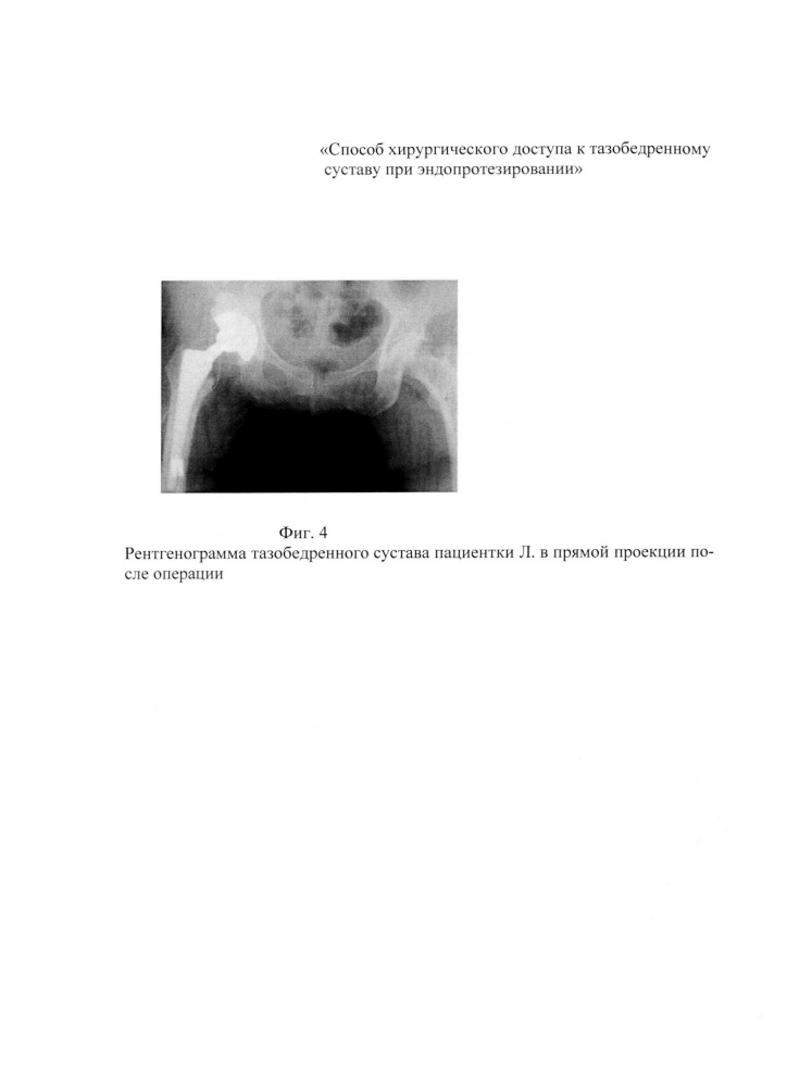 Способ хирургического доступа к тазобедренному суставу при эндопротезировании (патент 2638426)