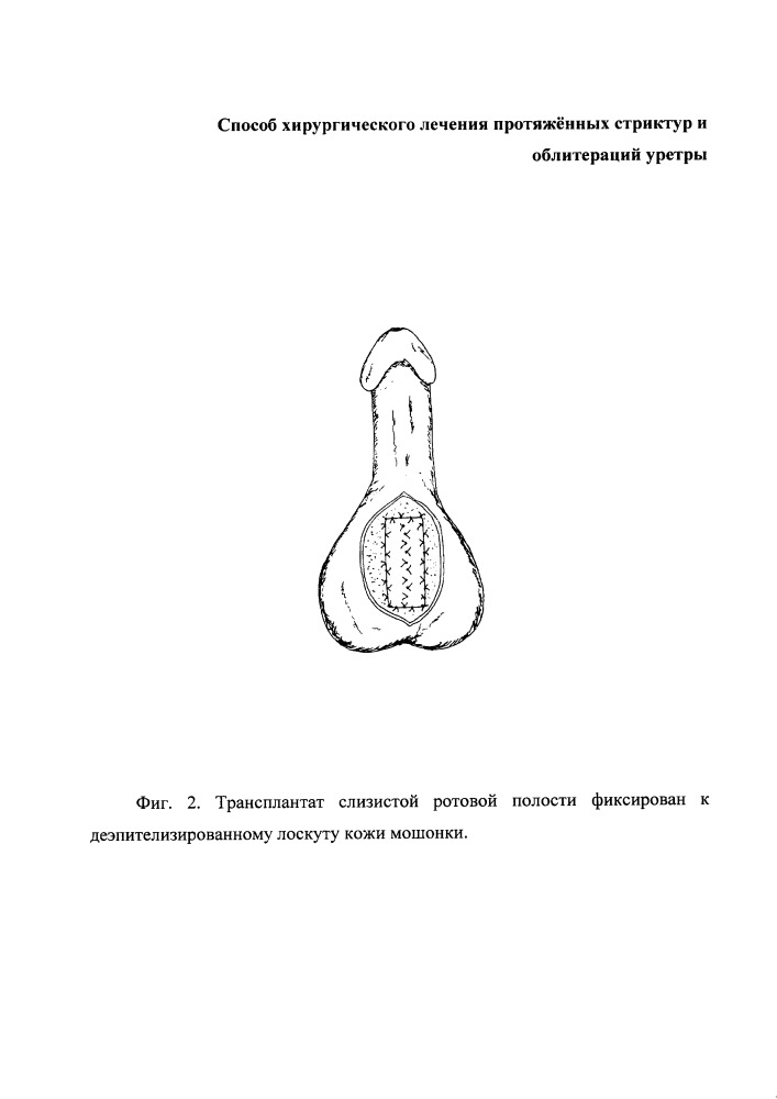 Способ хирургического лечения протяжённых стриктур и облитераций уретры (патент 2657939)