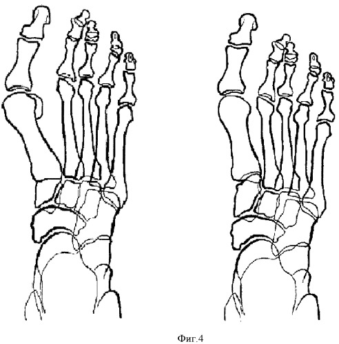 Способ оперативного лечения деформации переднего отдела стопы (патент 2428127)