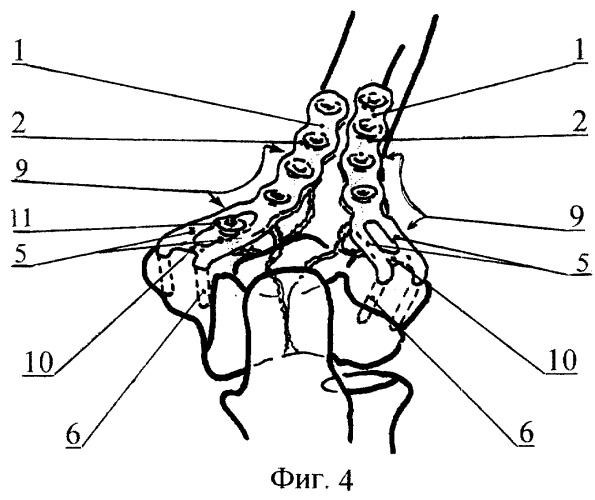 Вильчатая пластинка для остеосинтеза эпиметафизарных переломов (варианты) (патент 2266719)