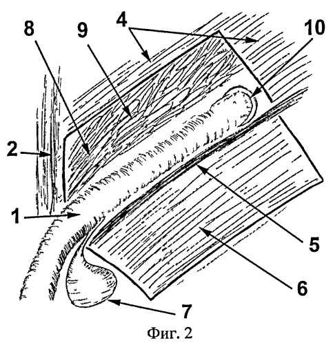 Способ безнатяжной паховой аутогерниопластики (патент 2400158)