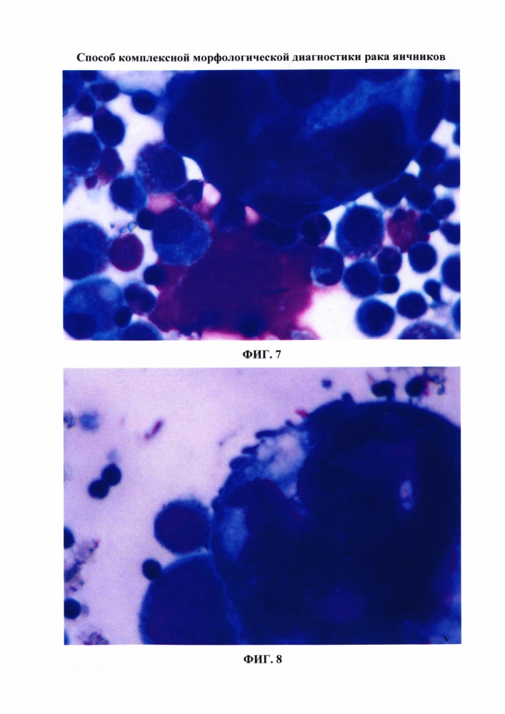 Способ комплексной морфологической диагностики рака яичников (патент 2640189)