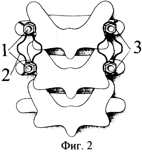 Устройство для внутренней транспедикулярной фиксации позвоночника (патент 2326617)