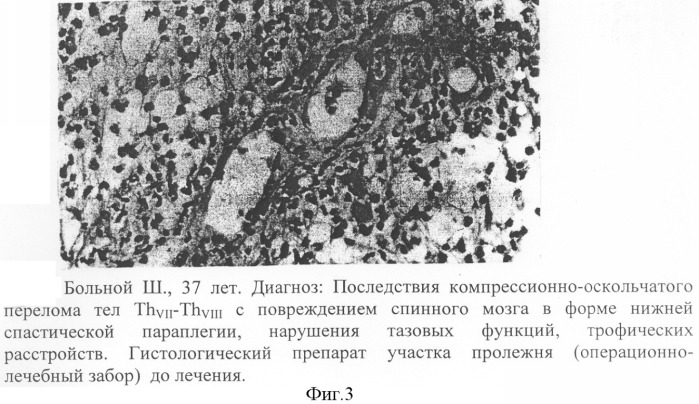 Способ лечения нейротрофических нарушений при последствиях травм спинного мозга (патент 2307679)