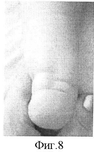 Способ лечения врожденной косолапости у детей первого года жизни (патент 2419405)