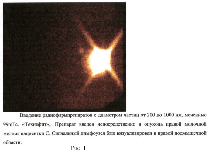 Способ определения сигнальных лимфатических узлов у больных рмж с помощью коллоидных рфп с различным диаметром частиц (патент 2469334)