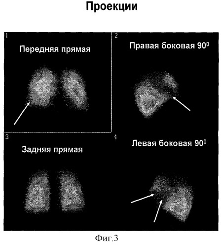 Способ дифференциальной диагностики острых инфекционных заболеваний легких и тромбоэмболий мелких ветвей легочной артерии (патент 2310385)