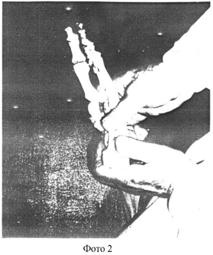 Способ закрытой ручной репозиции переломов лодыжек (патент 2332184)