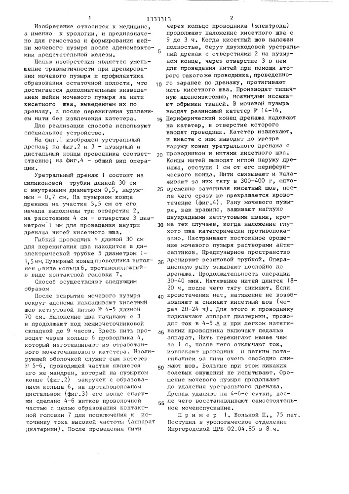 Способ чреспузырной аденомэктомии (патент 1333313)