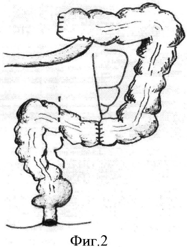 Способ хирургической реабилитации после экстирпации прямой кишки (патент 2547249)