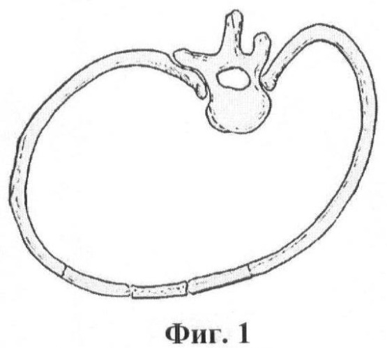 Способ хирургического лечения тяжелых сколиозов с коррекцией вогнутой деформации грудной клетки (патент 2449734)