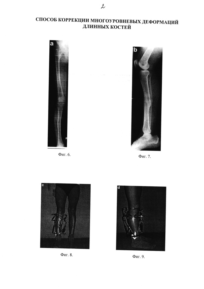 Способ коррекции многоуровневых деформаций длинных костей (патент 2640999)