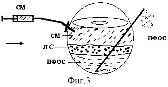 Способ лечения пролиферативной витреоретинопатии (патент 2284812)