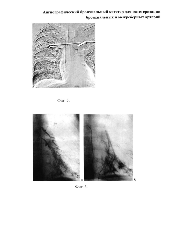 Ангиографический бронхиальный катетер для катетеризации бронхиальных и межреберных артерий (патент 2661417)