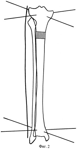 Способ коррекции формы голени с использованием чрескостного остеосинтеза и стержень-шуруп для его выполнения (патент 2480176)