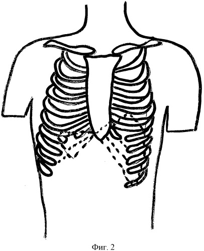Способ лечения больных с обширными дефектами передней грудной стенки (патент 2528965)
