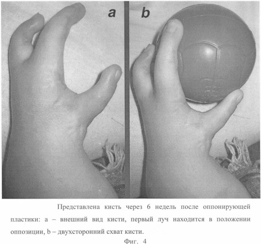 Способ создания двухстороннего схвата кисти (патент 2339330)