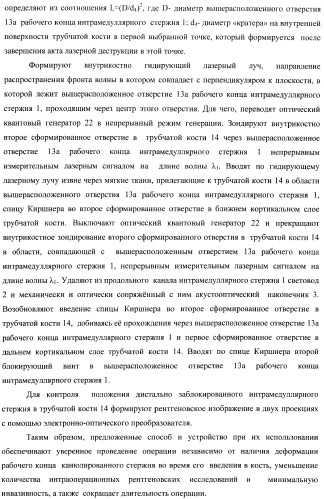 Способ дистального блокирования интрамедуллярных стержней при остеосинтезе длинных трубчатых костей и устройство для его осуществления (патент 2387401)