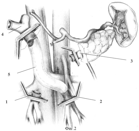 Способ панкреатодуоденальной резекции при местнораспространенном раке периампулярной области с обширной опухолевой инвазией магистральных вен мезентерико-портальной системы и наличием двух основных стволов верхней брыжеечной вены (патент 2317018)