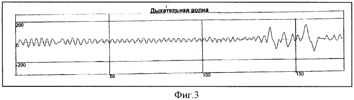 Способ определения типа демпинг-реакции при демпинг-синдроме (патент 2334456)