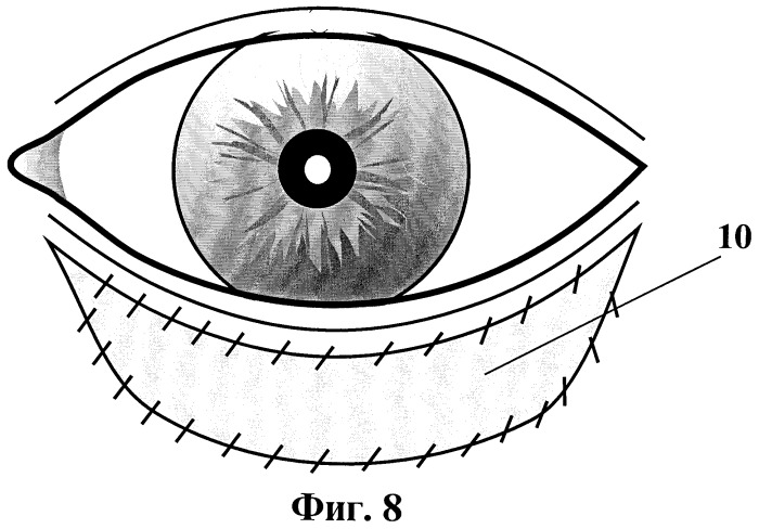 Способ хирургического лечения рубцового выворота нижнего века (патент 2248193)
