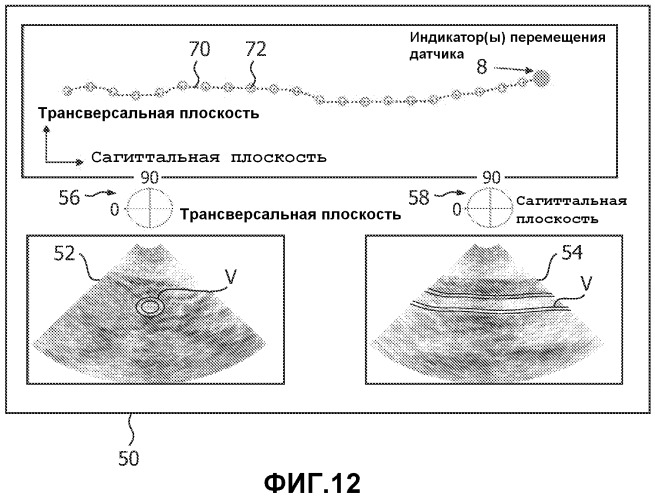 Получение ультразвуковых изображений с расширенным полем зрения с помощью направляемого сканирования с efov (патент 2519811)