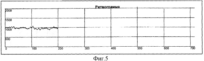 Способ определения типа демпинг-реакции при демпинг-синдроме (патент 2334456)