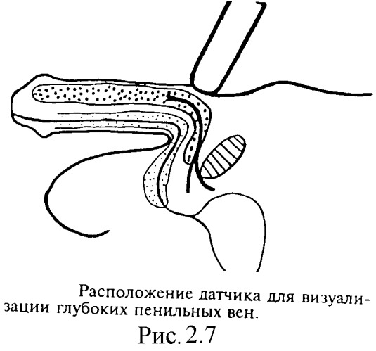 Способ диагностики васкулогенной эректильной дисфункции (патент 2336820)